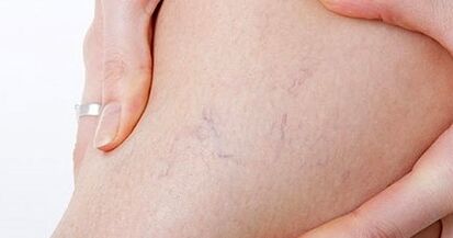 A etapa inicial das varices nas pernas