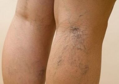 Varices