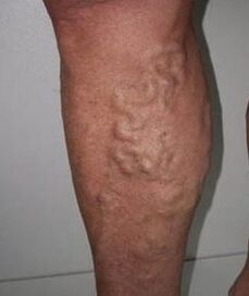 Veas varices executadas
