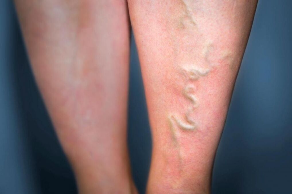 varices
