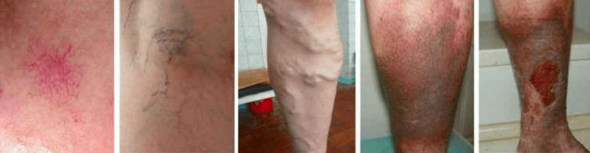Etapas de varices nas pernas