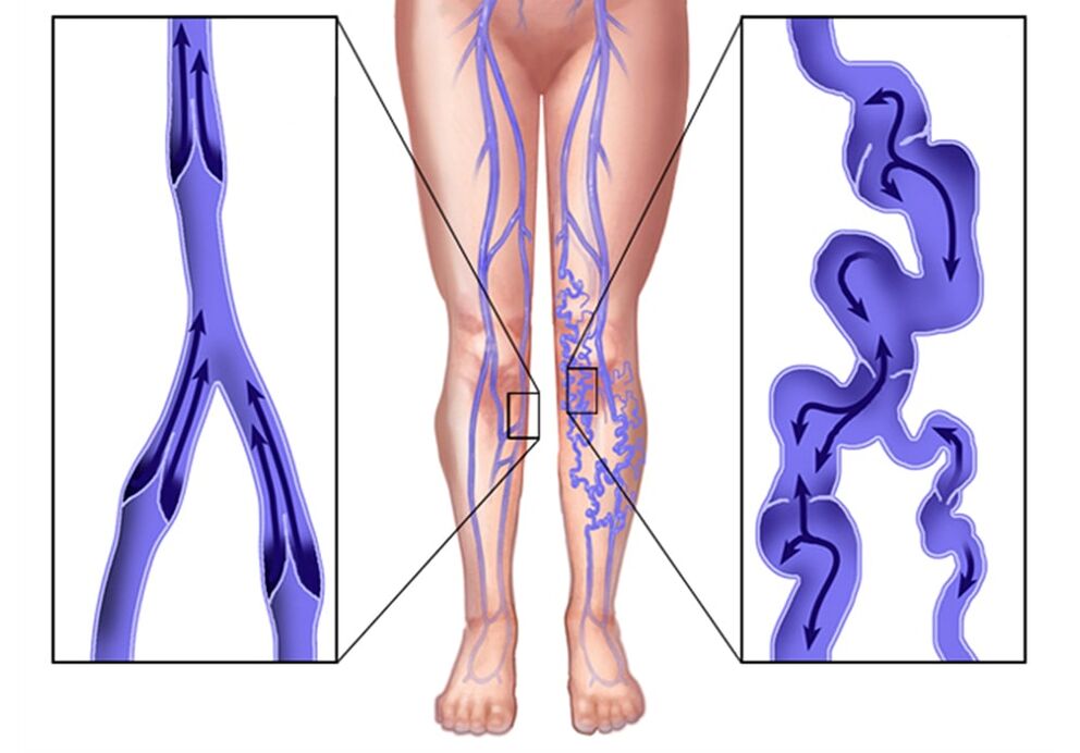 Como son as varices