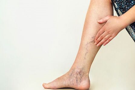 Varices