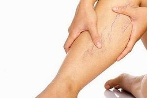 As razóns para o desenvolvemento de varices nas pernas