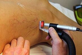 Os métodos de tratamento das varices das varices