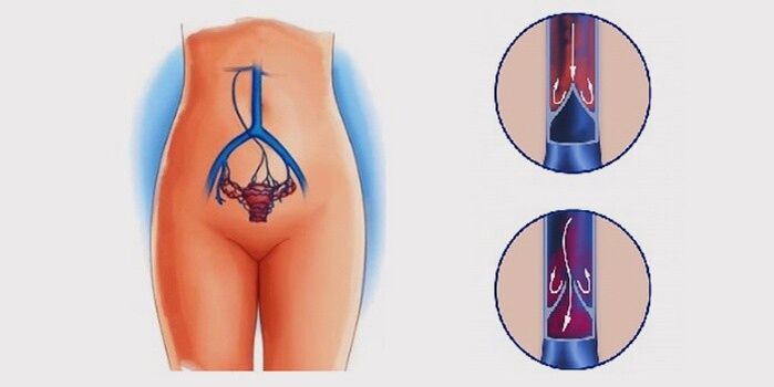Por que se producen varices na pelve